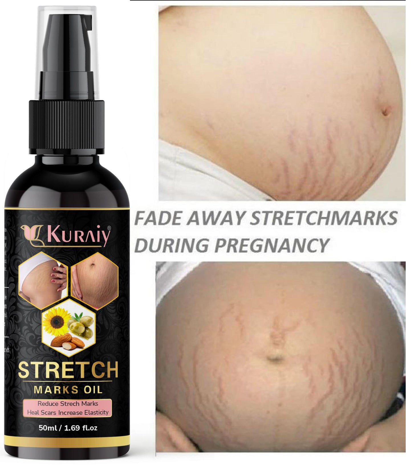 SparkPetal Natural Stretch Marks Removal Oil - Heal Pregnancy, Breast, Hip, Legs Marks (50ml)