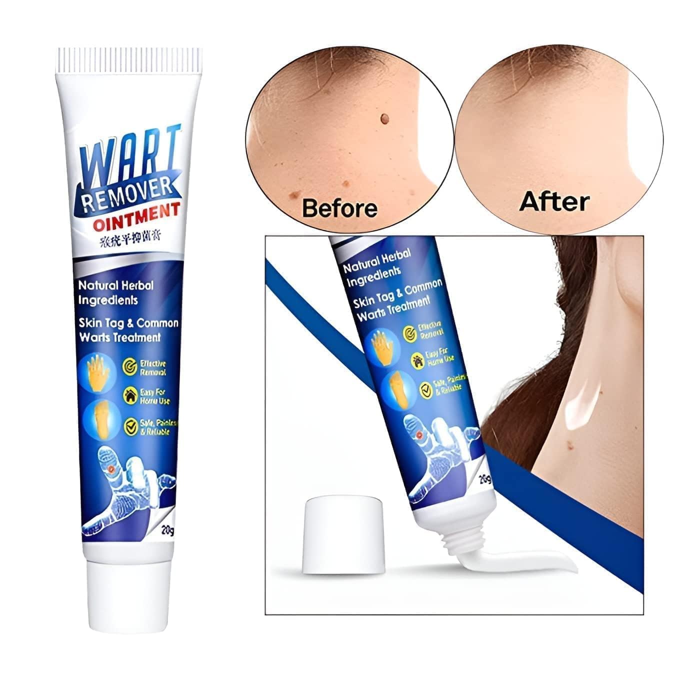 Wart Remover Instant Blemish Removal Cream - Natural Herbal Formula (20gm Each, Pack of 2)